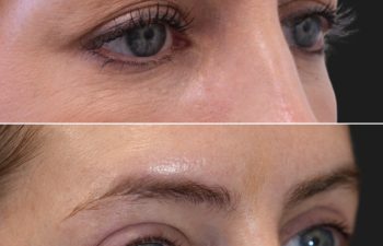 40 year-old before and 3 months after upper eyelid lift, lower blepharoplasty, mini brow lift, and TCA peel, oblique right view