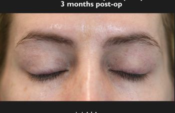 Patient's closed eyes showing the subtle blepharoplasty scar beneath the eyelid crease.