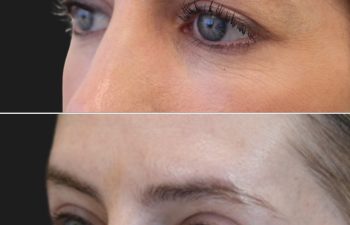 40 year-old before and 3 months after upper eyelid lift, lower blepharoplasty, mini brow lift, and TCA peel, oblique left view