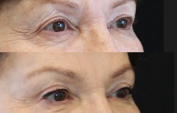 75 year-old patient before and 10 months after a temple lift, upper blepharoplasty, and fat & nanofat grafting to the face.