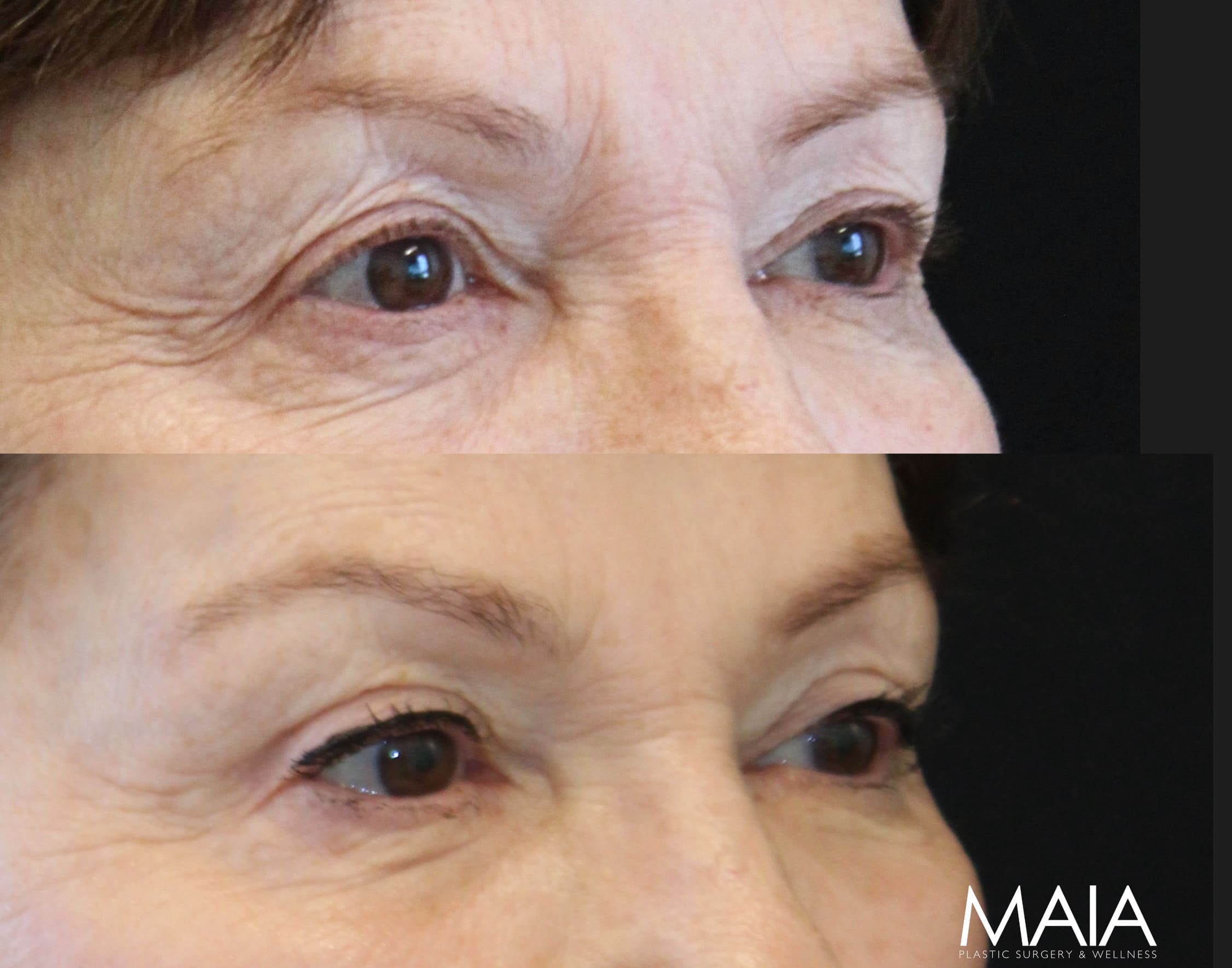 75 year-old patient before and 10 months after a temple lift, upper blepharoplasty, and fat & nanofat grafting to the face.