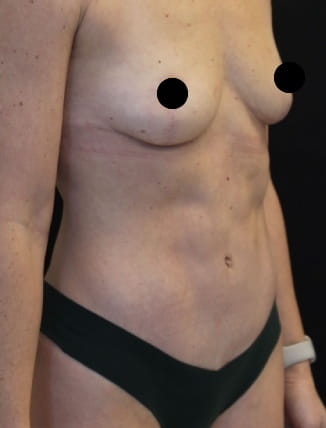 36-year-old patient, after tummy tuck, extended hernia repair and breast lift